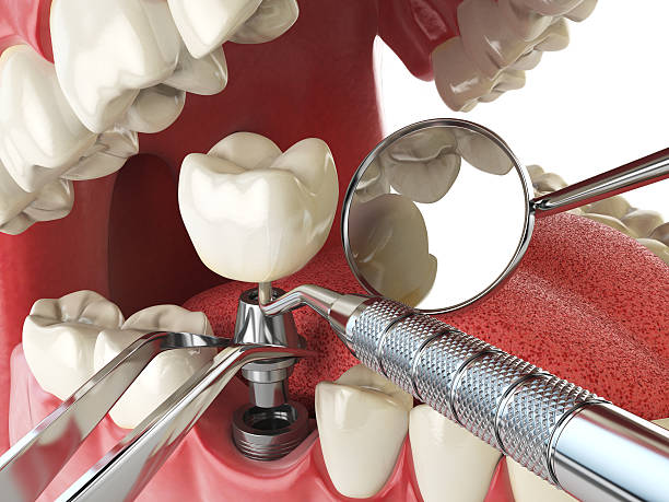 Best Emergency Dentist for Lost Fillings or Crowns in Flippin, AR